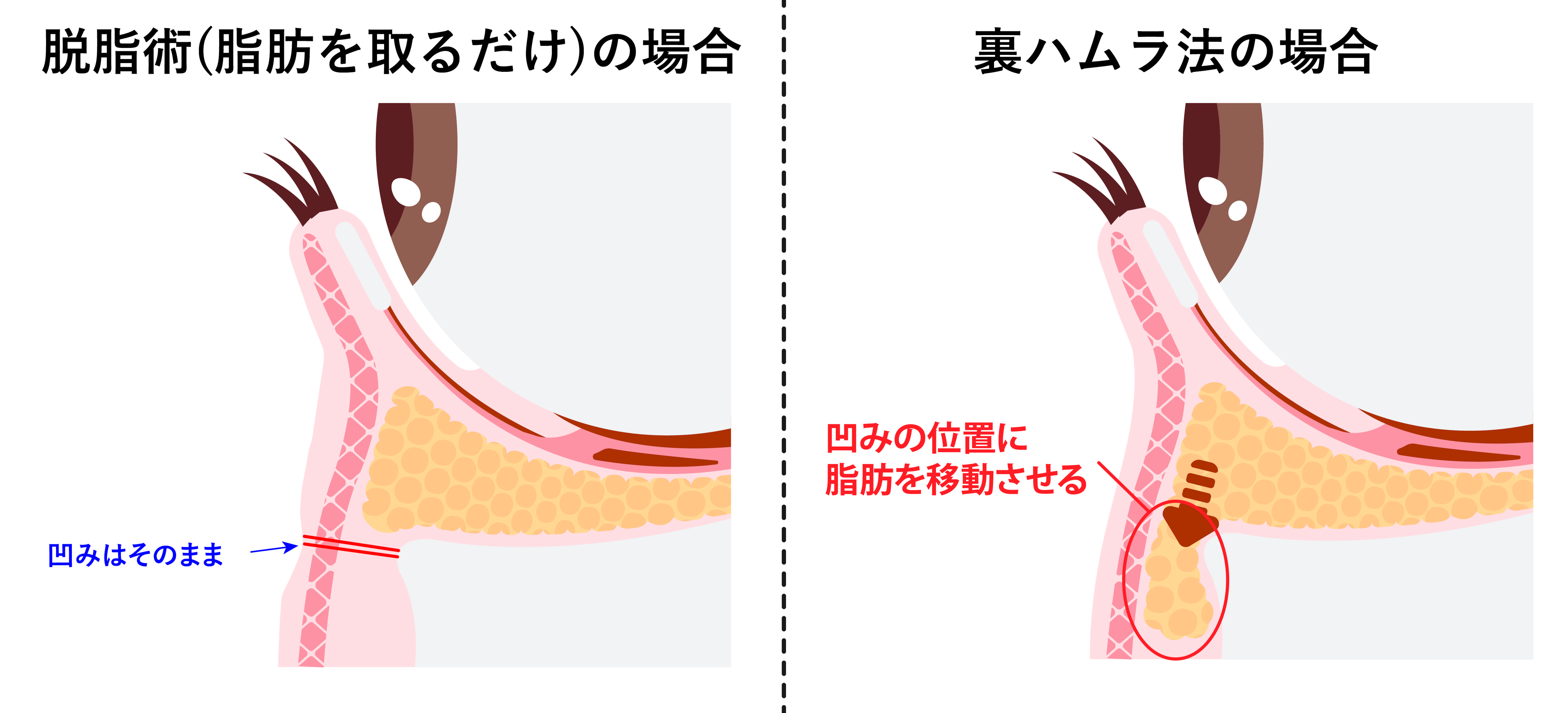 「脱脂術」との決定的な違い