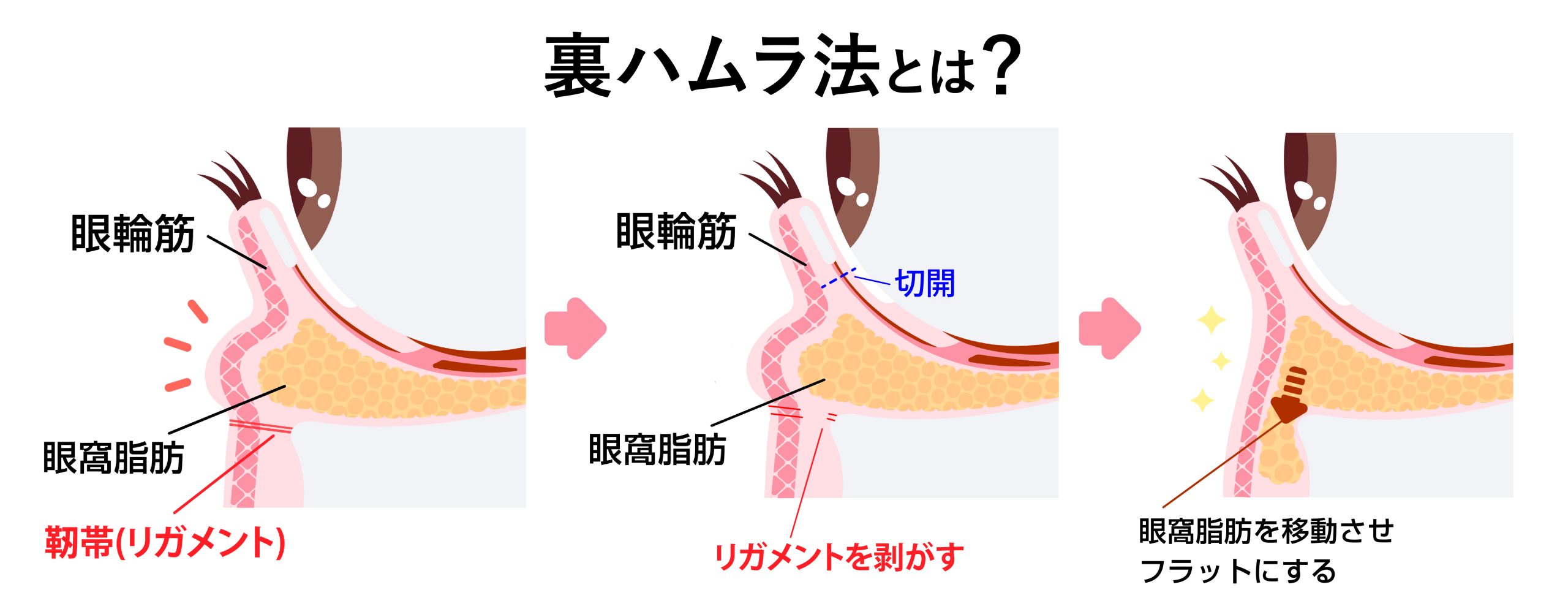 裏ハムラ法とは?|自身の脂肪を再配置する究極の根本治療