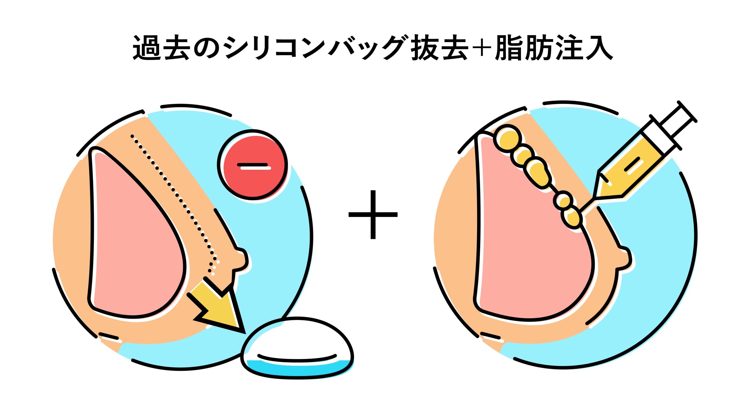 ②バッグの摘出（抜去）＋脂肪注入豊胸<br />
