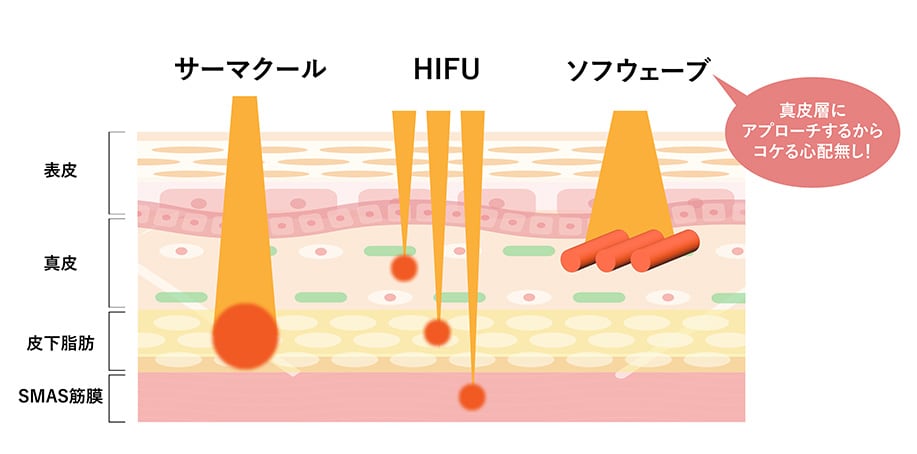 他のたるみ治療との違い<br />
