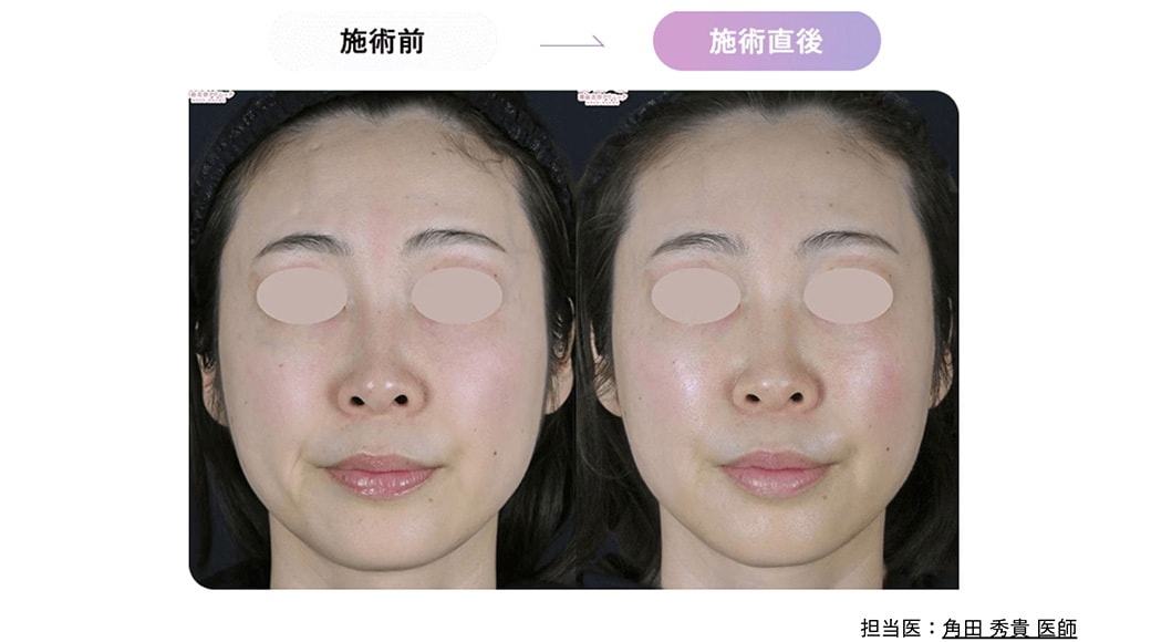 施術直後から引き締まる！<br />
