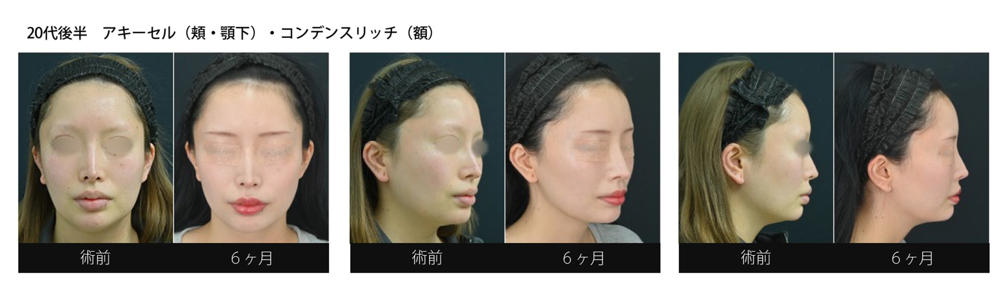 顎下の脂肪をおでこに移動！