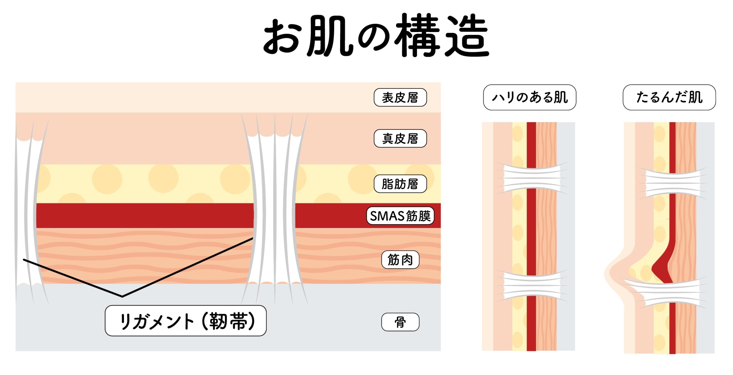 たるみの根本原因、伸びてしまった「リガメント（靭帯）」