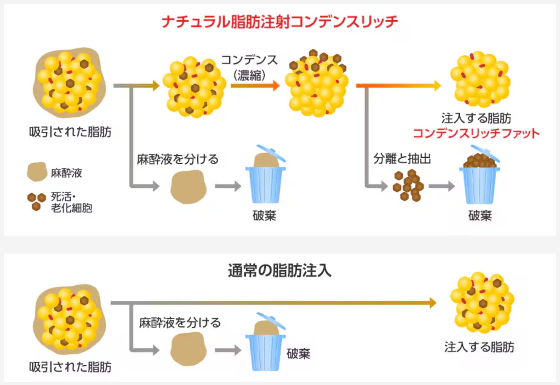 ナチュラル脂肪注射コンデンスリッチ(脂肪注入)とは?
