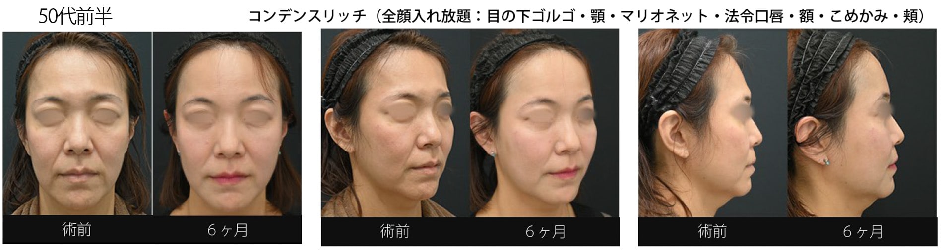 顔の脂肪注入し放題!