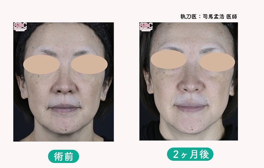 術後2ヶ月後