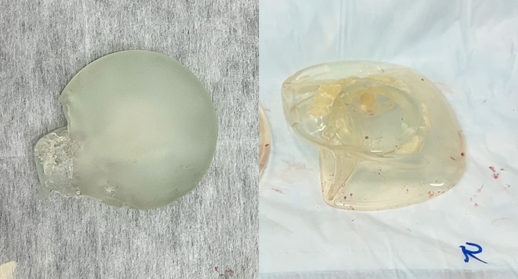 シリコンバッグ破損・石灰化の危険性<br />
