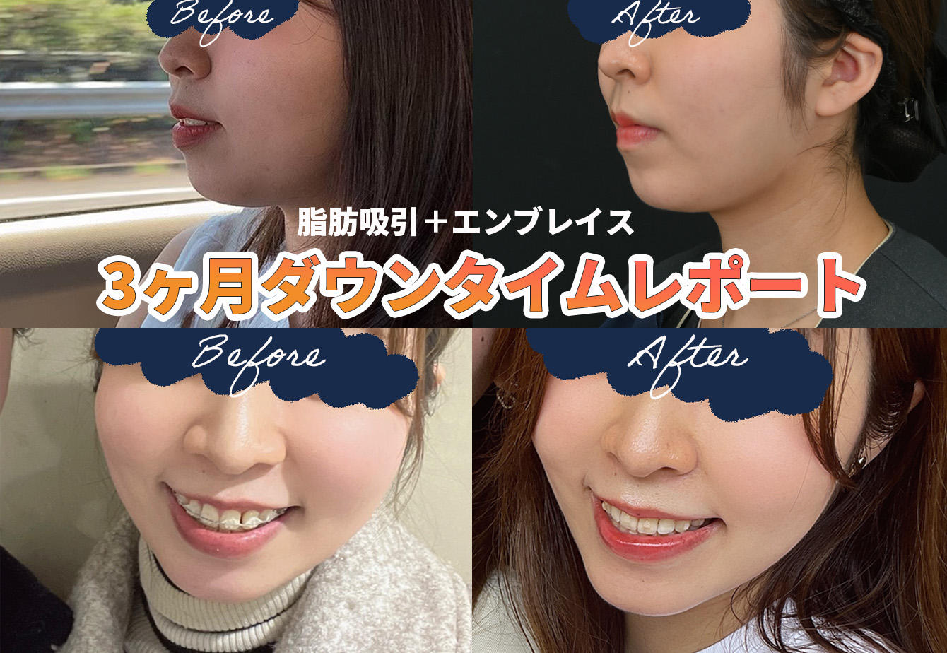 顔の脂肪吸引とエンブレイスのダウンタイムについて。脂肪吸引するなら 