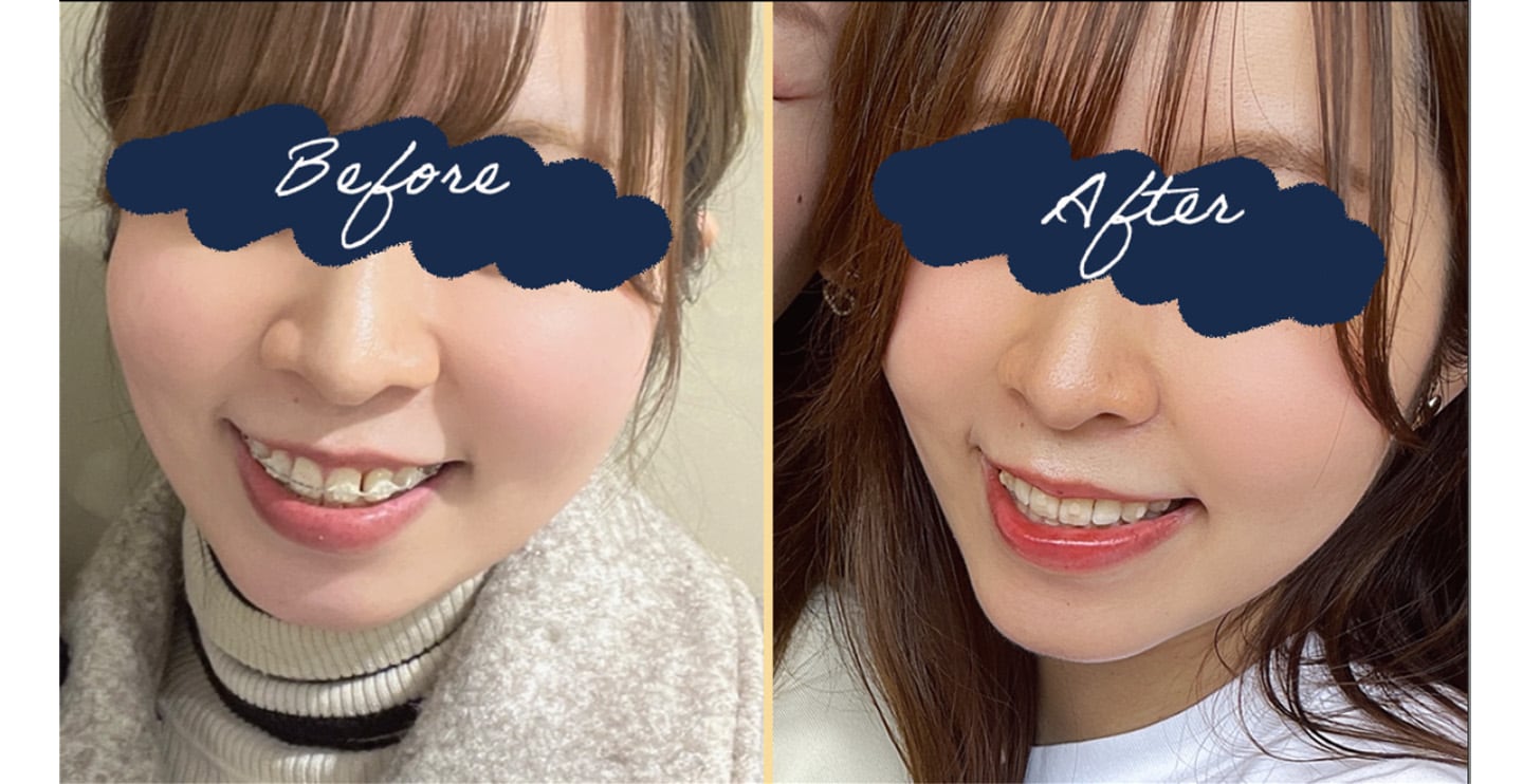 脂肪吸引とエンブレイスのダウンタイムレポートはいかがでしたか？