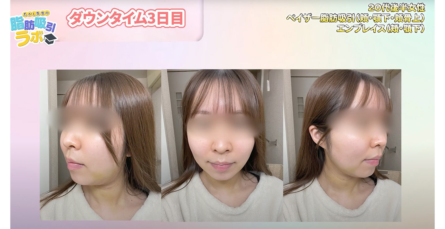 【ダウンタイム３日目】