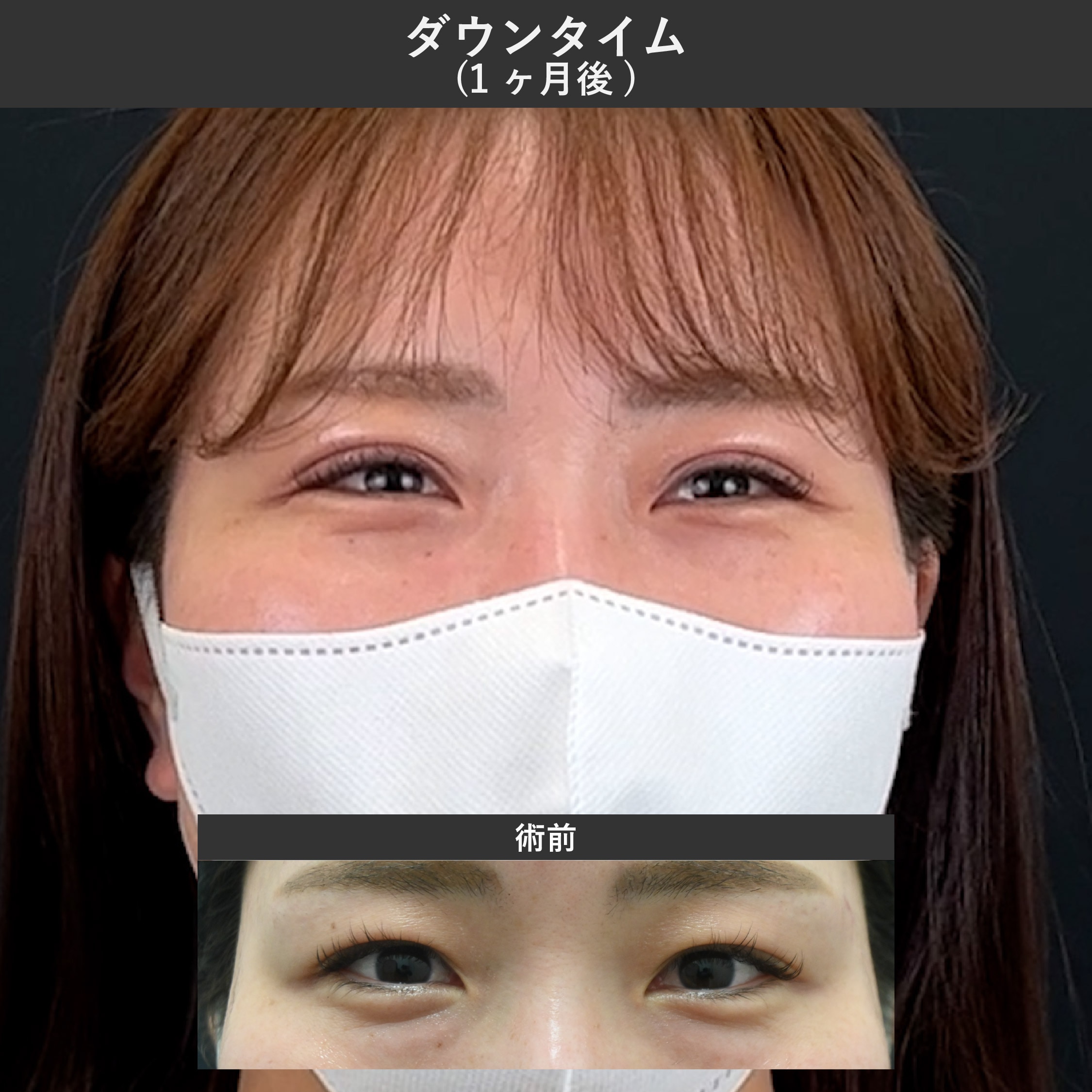 術後1ヶ月：ほぼ完成！