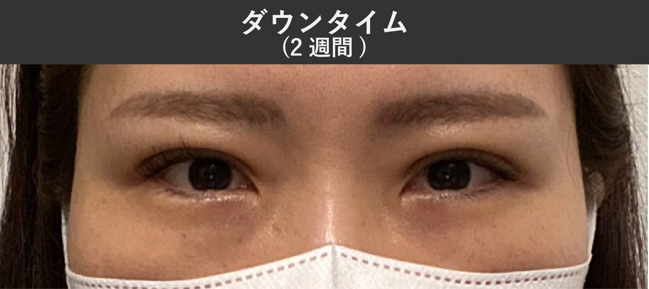 術後2週間：ほとんど気にならないレベルに