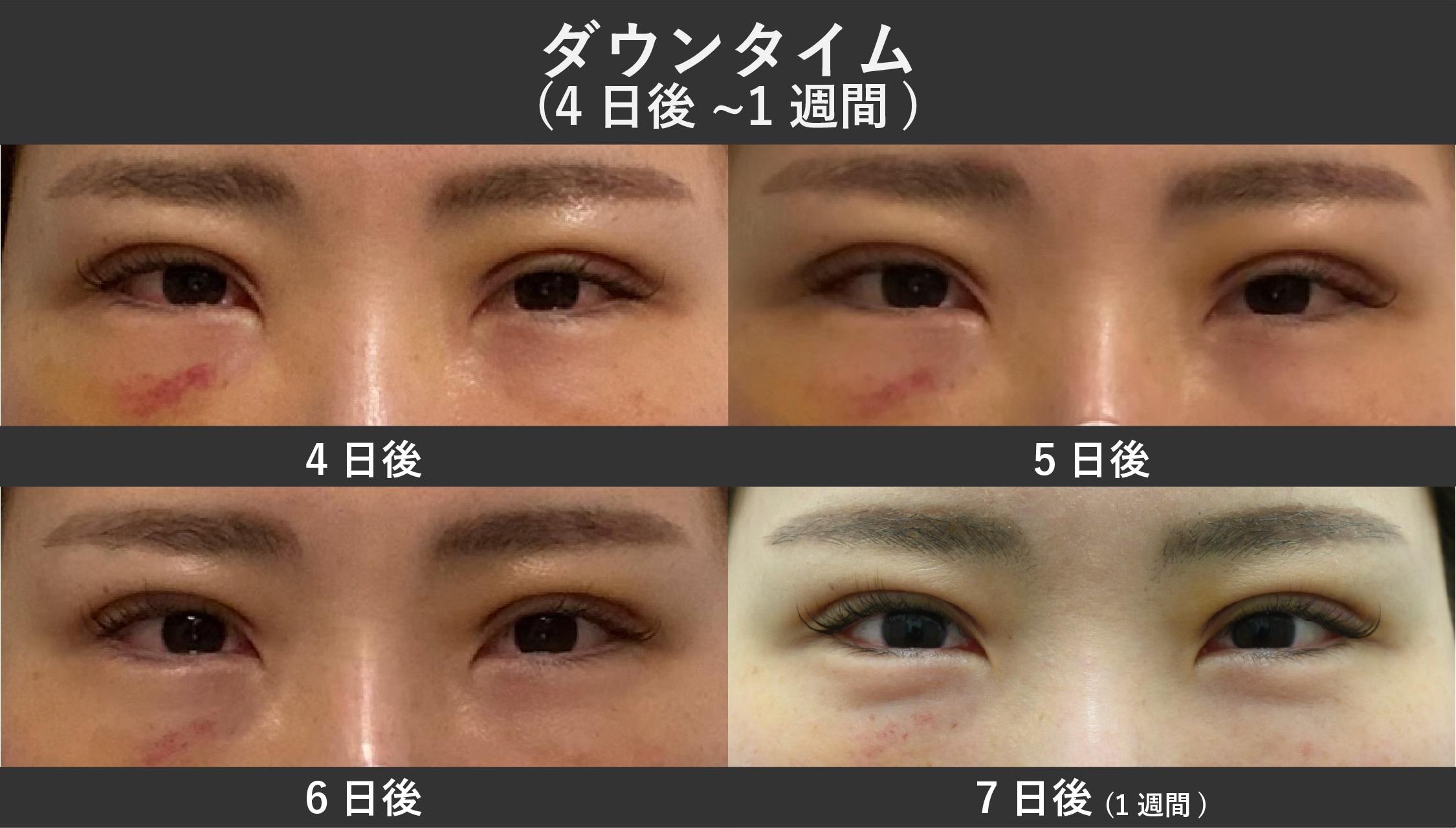 【術後4日目〜1週間】大きな腫れが引き、メイクで隠せるように