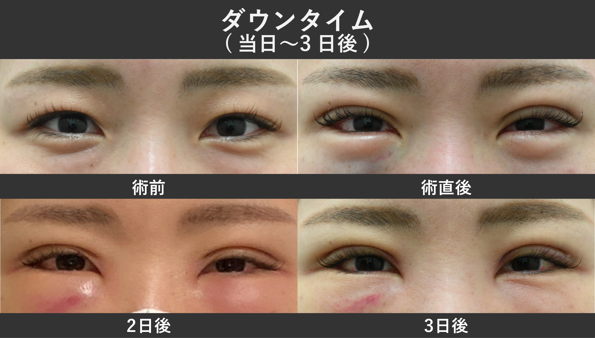 【施術当日〜3日目】腫れと内出血のピーク
