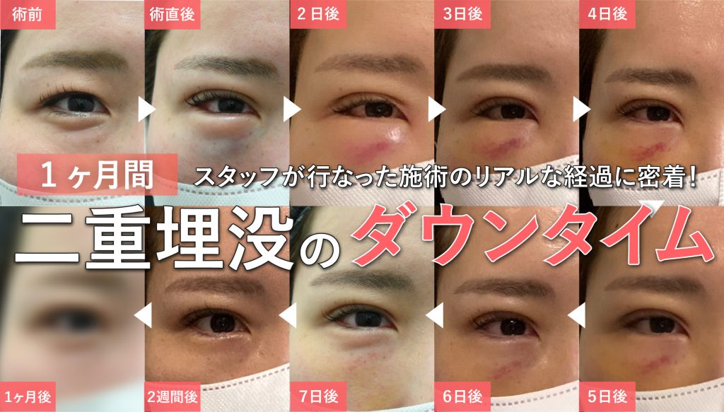 二重ダウンタイム_表紙