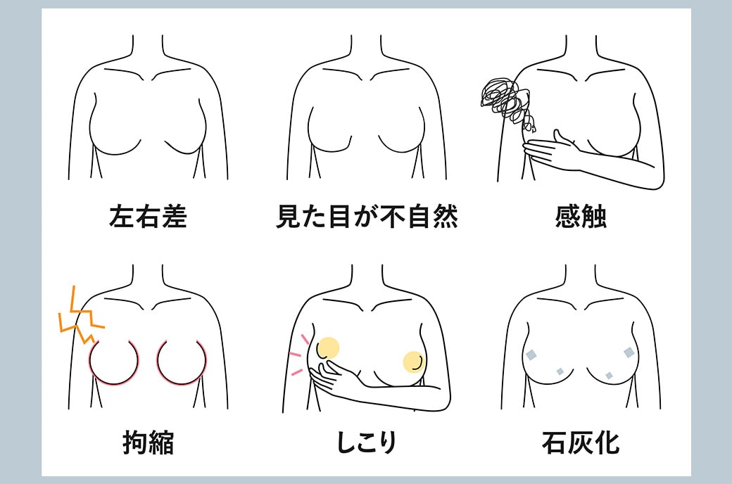 豊胸手術で起こりうる主なリスク<br />
