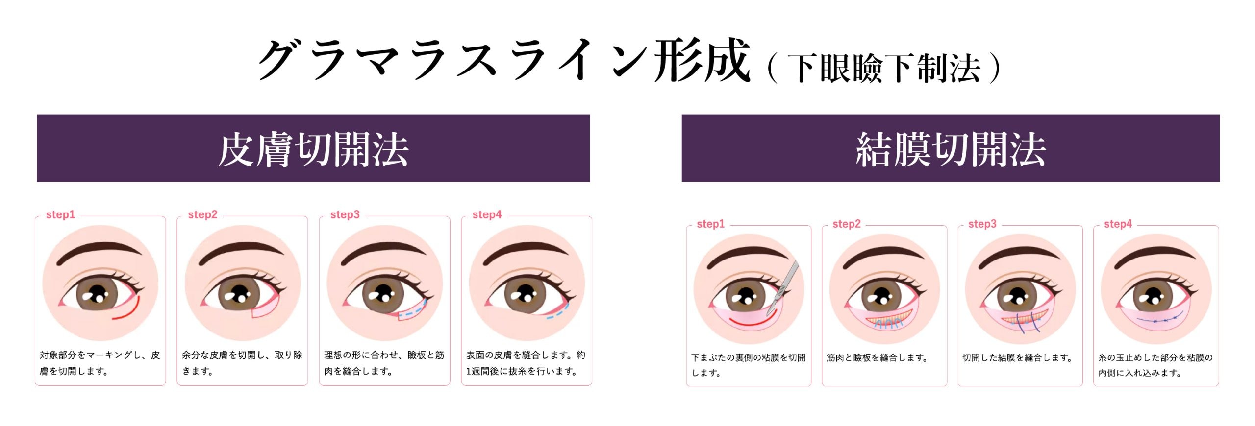 グラマラスライン形成（下眼瞼下制法）