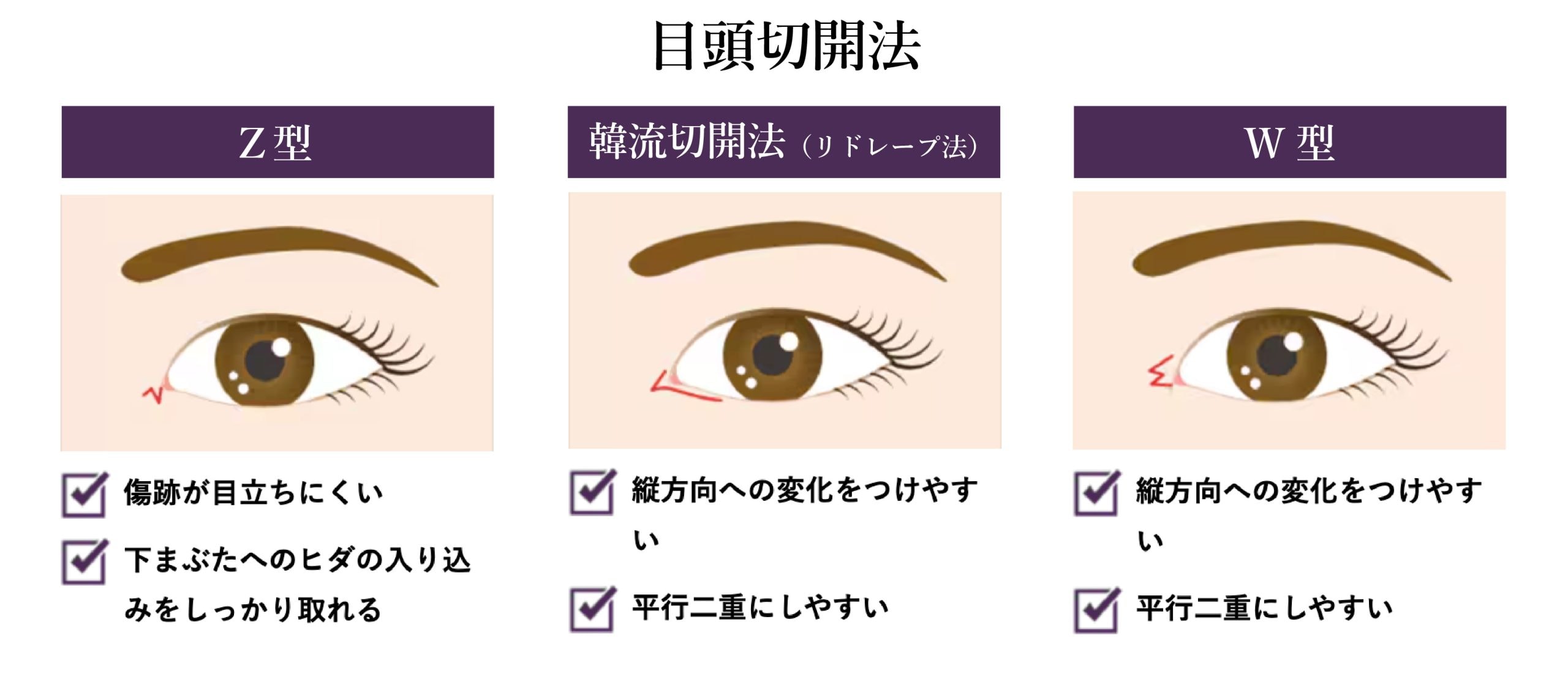 目頭切開（Z形成・W形成など）