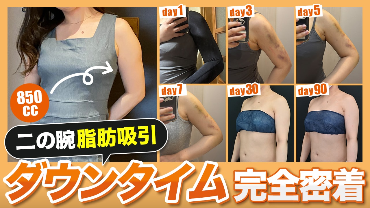【完全密着】生活に支障ある？二の腕の脂肪吸引のダウンタイムの全て　【湘南美容クリニック 名古屋院】