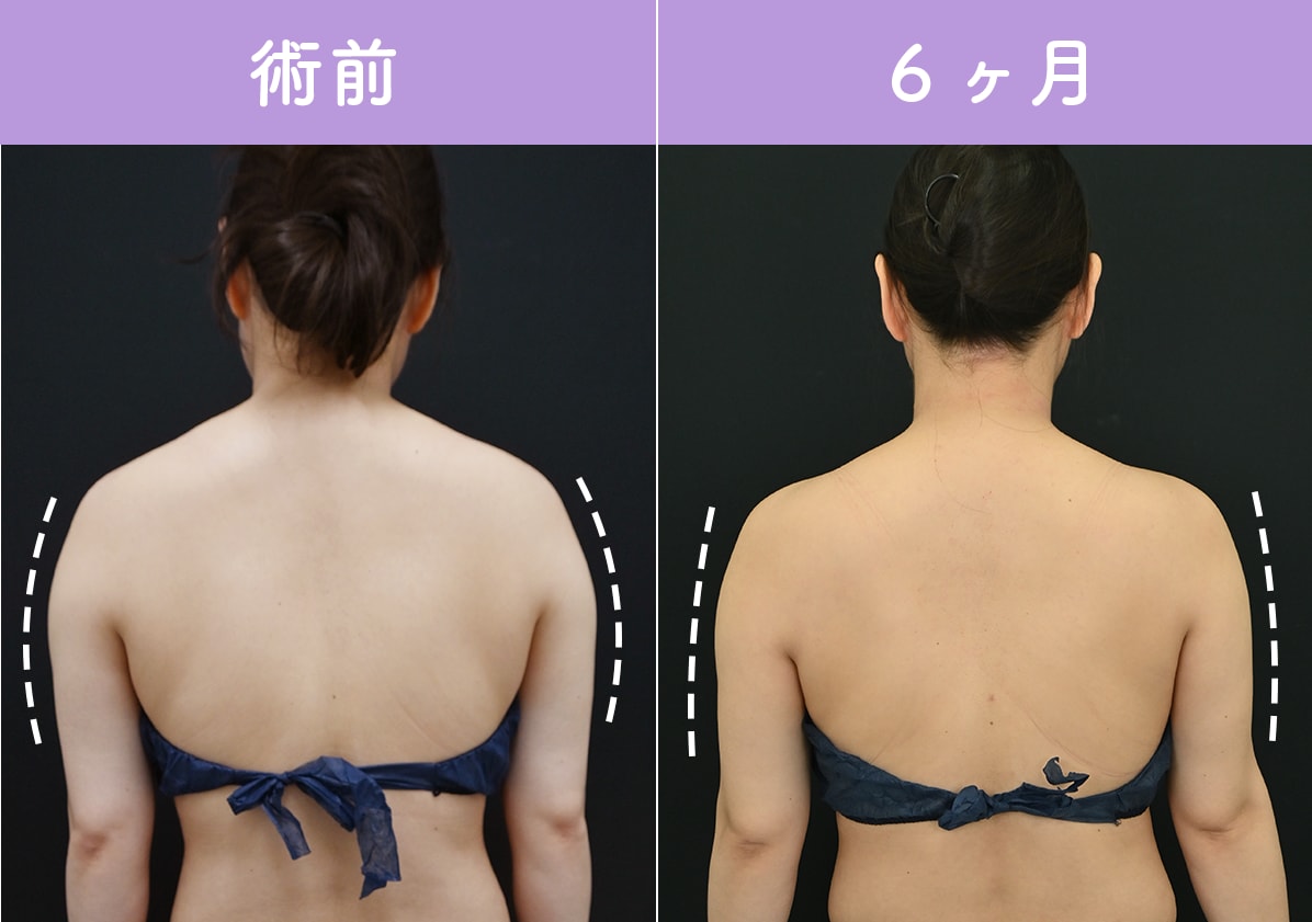 ベイザー脂肪吸引（上腕＋肩＋肩甲骨横上＋背中＋胸上部）エンブレイスRF（二の腕）