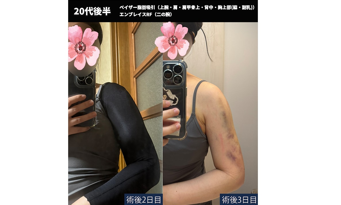 【術後２日目、３日目】