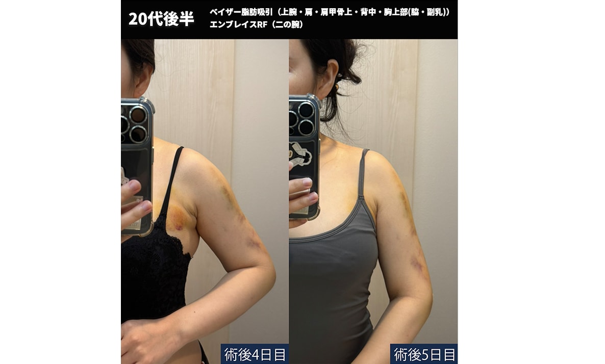 【術後4日目、5日目】