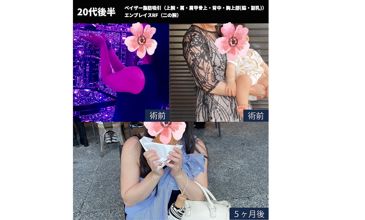 【術後５ヶ月後】