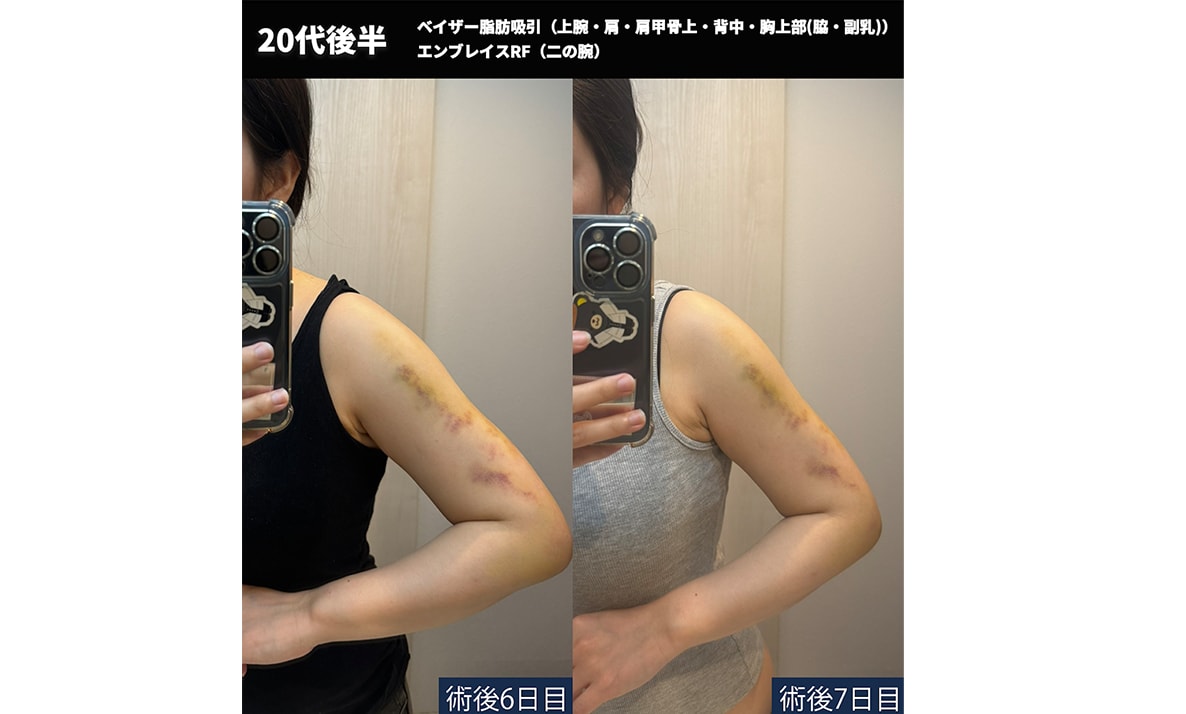 【術後６日目、７日目】