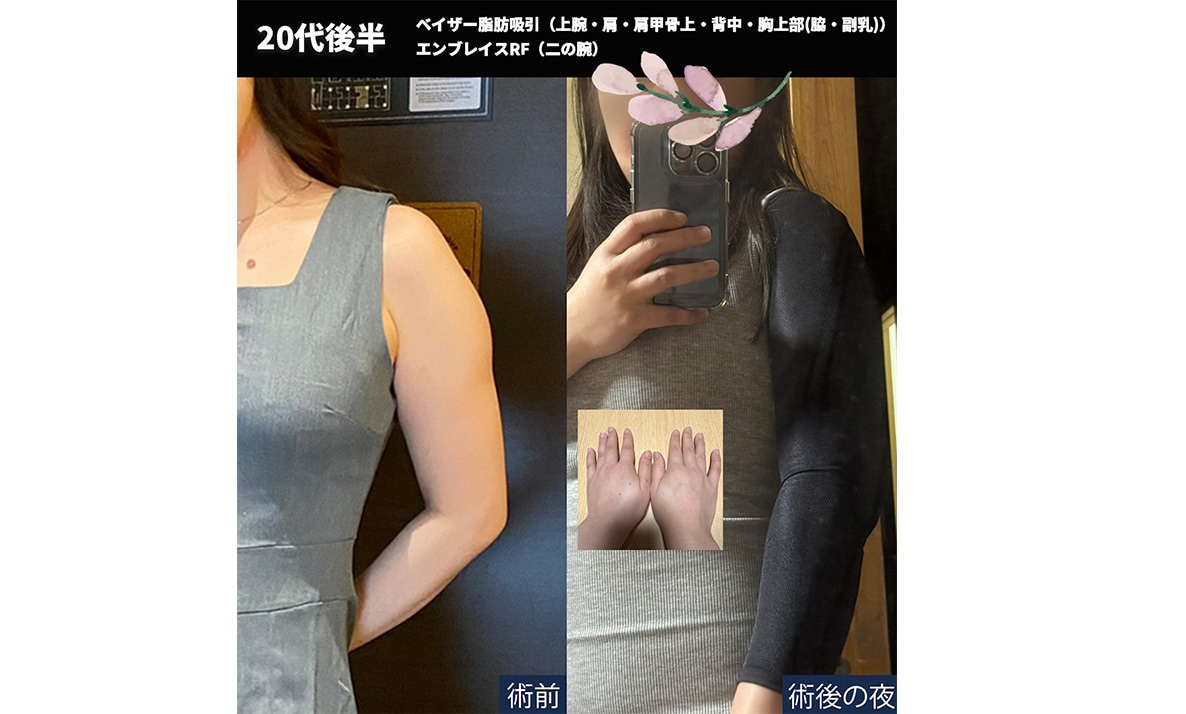 【手術当日の夜】