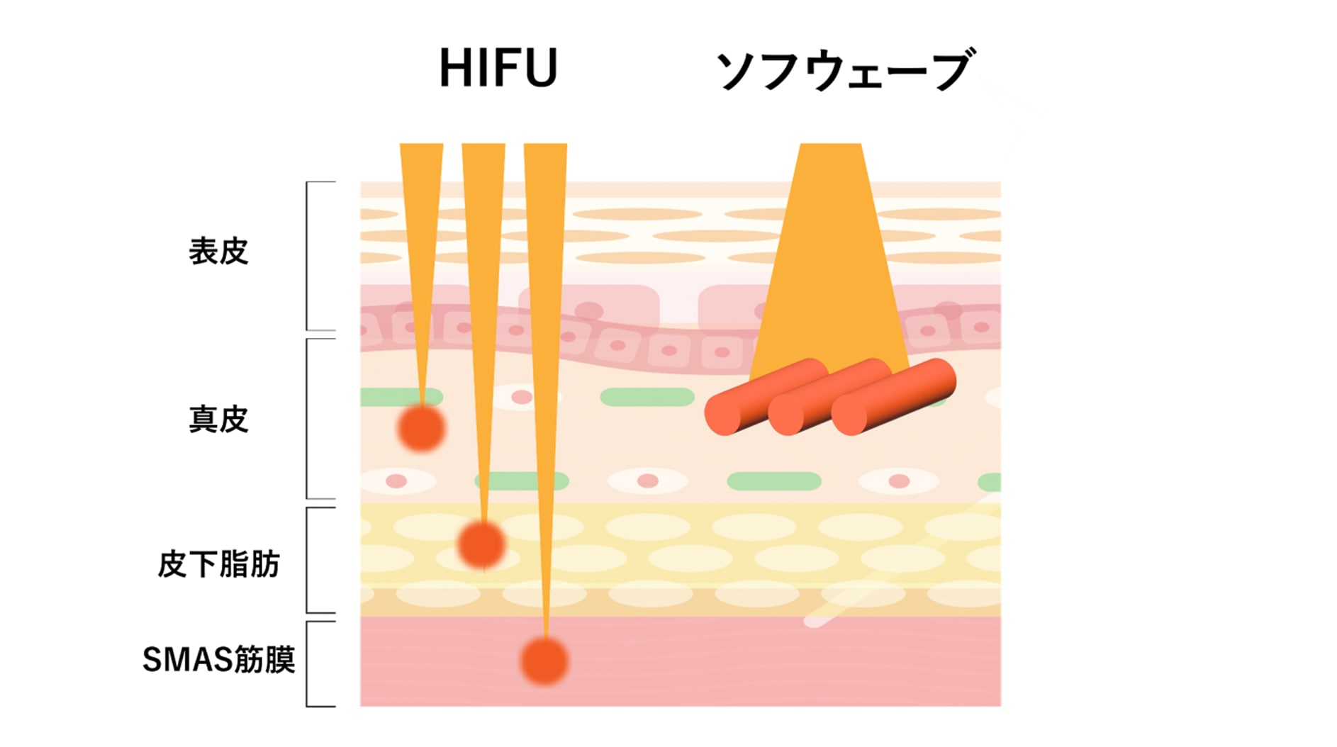 HIFUとソフウェーブの違いは？