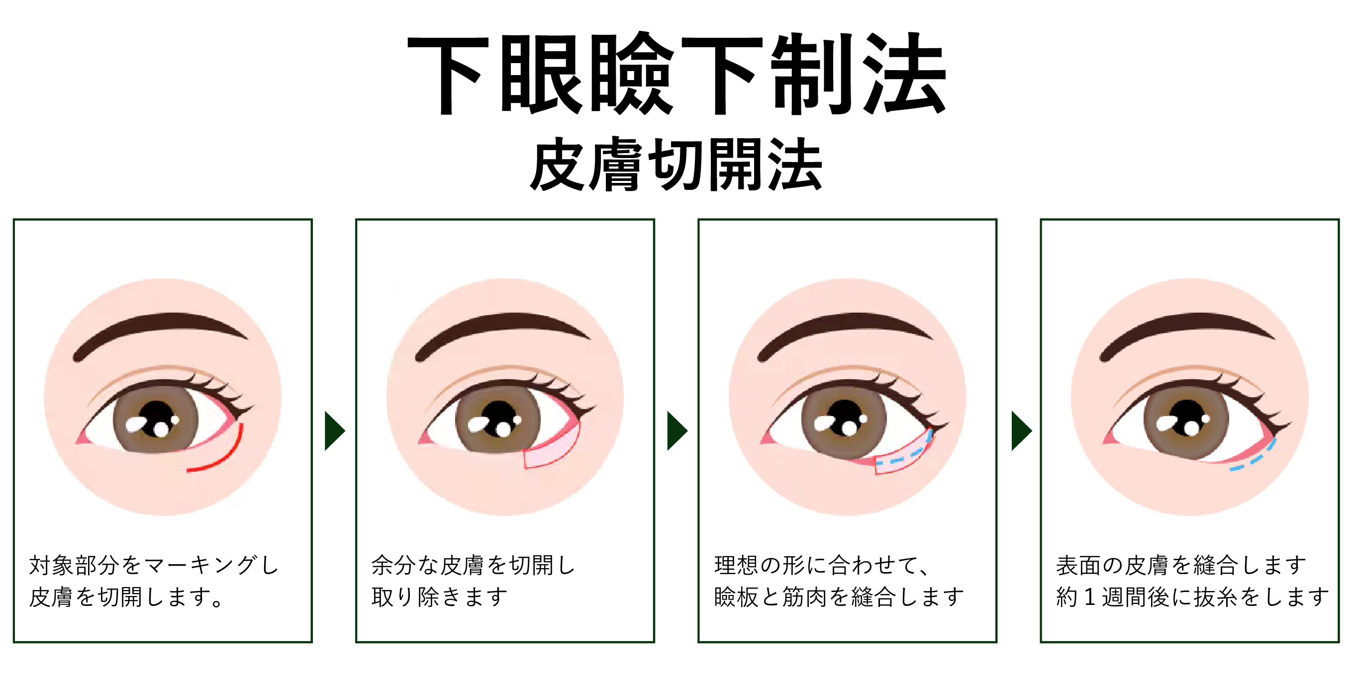 ②-2 皮膚切開法
