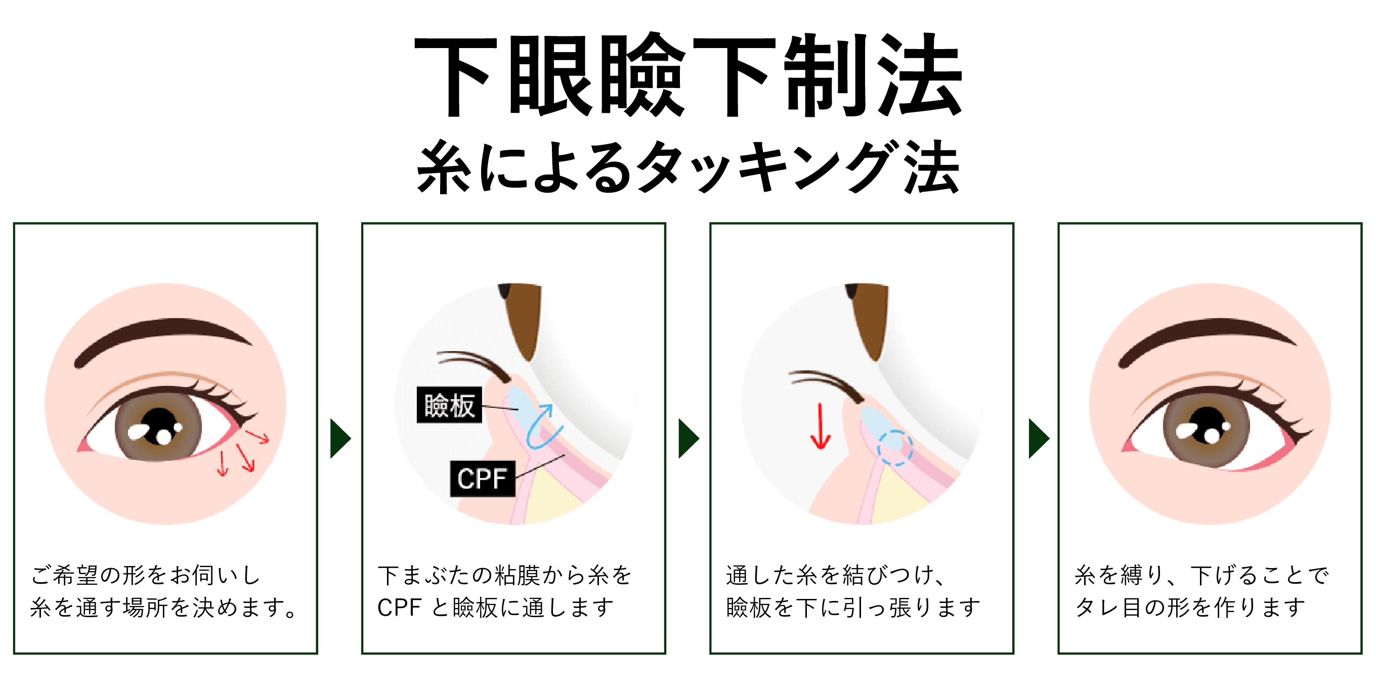 ① 糸によるタッキング法