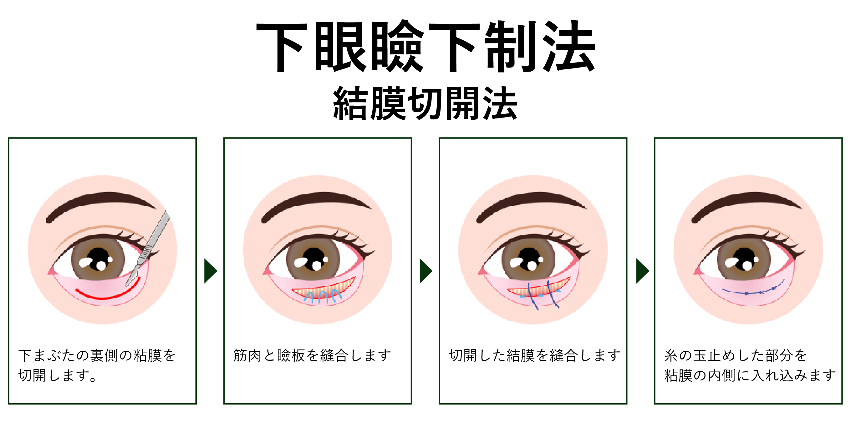 ②-1 結膜切開法
