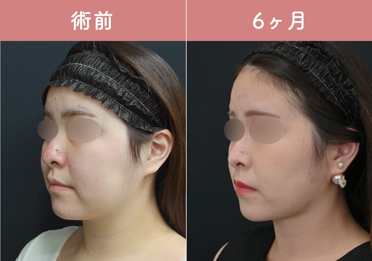 ②法令線に脂肪が乗ってしまい、法令線が深く見える