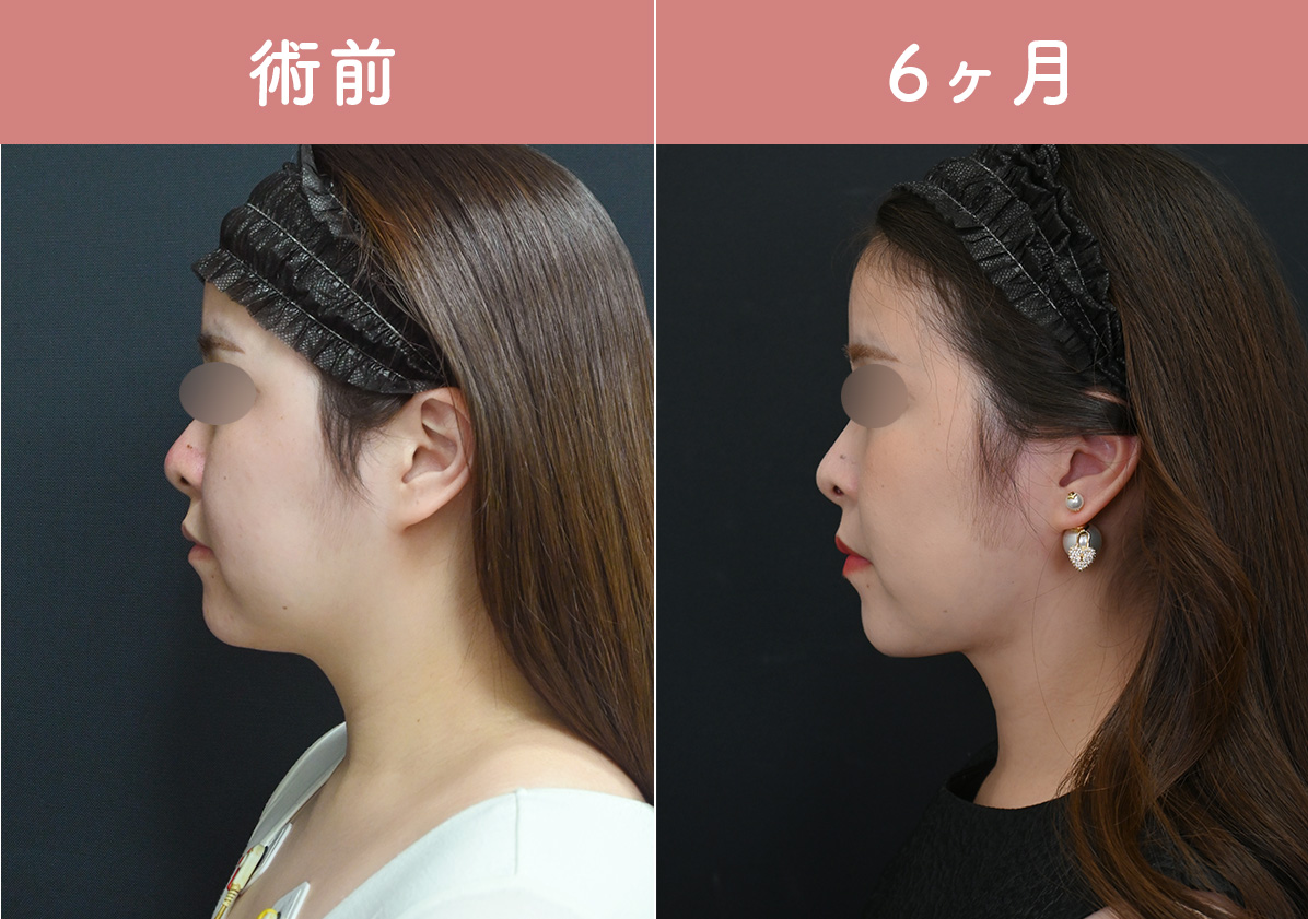 ③横から見た時に鼻が埋まって見える