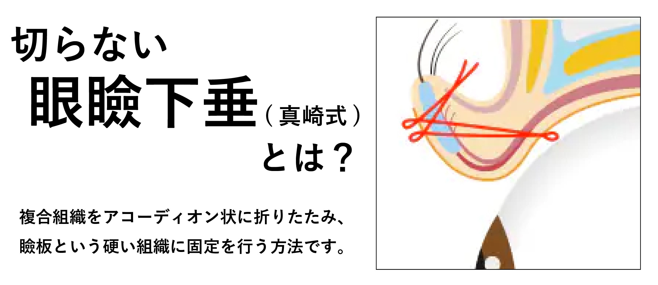 切らずに瞼の開きを改善