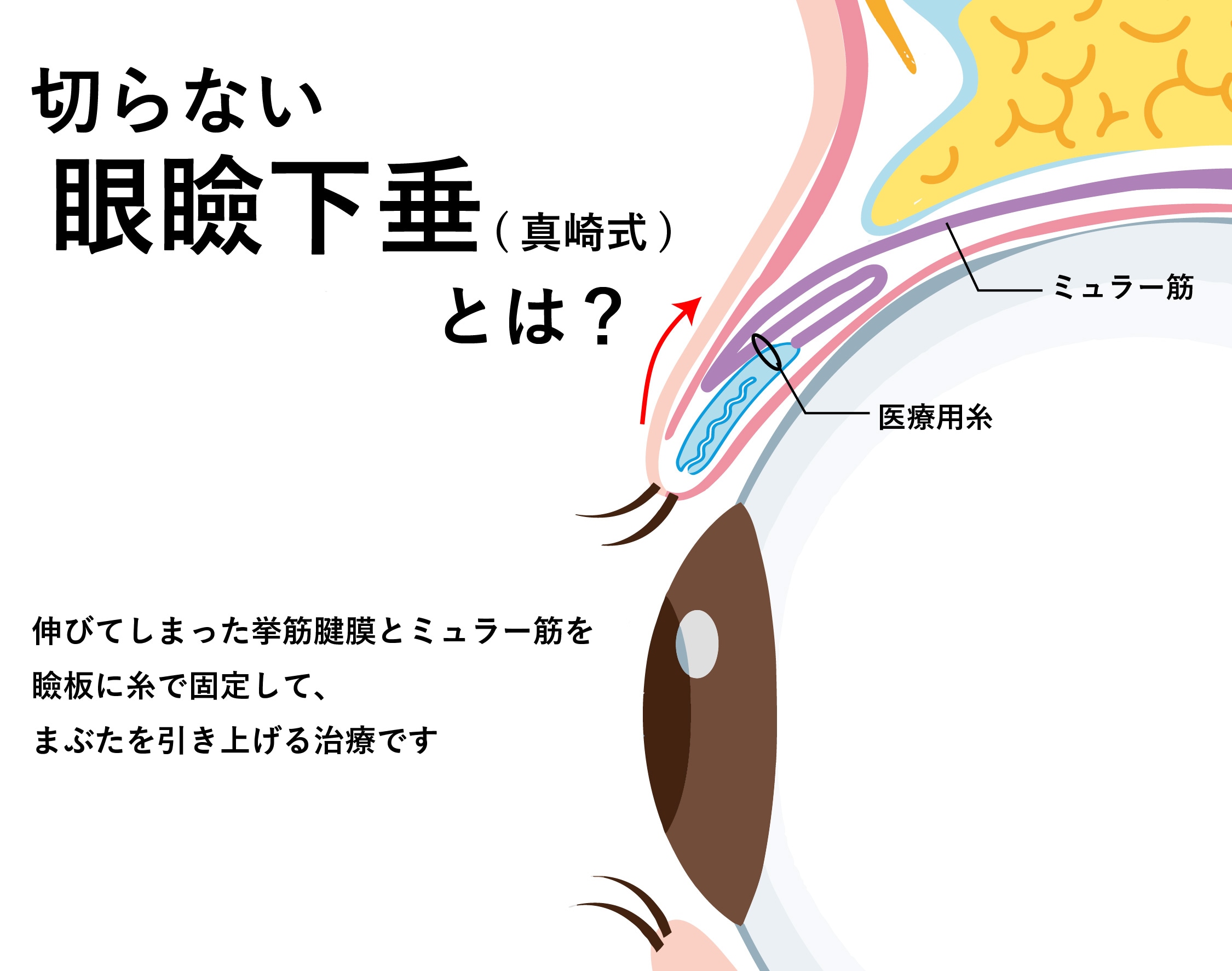 切らずに瞼の開きを改善