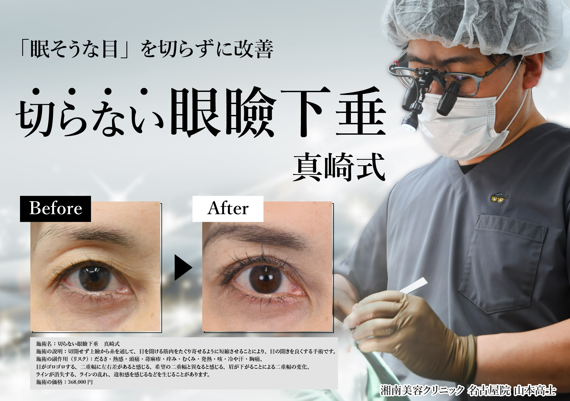 【名古屋】「まぶたが重い」…それ眼瞼下垂かも?切らない眼瞼下垂(真崎式)|湘南美容クリニック名古屋院