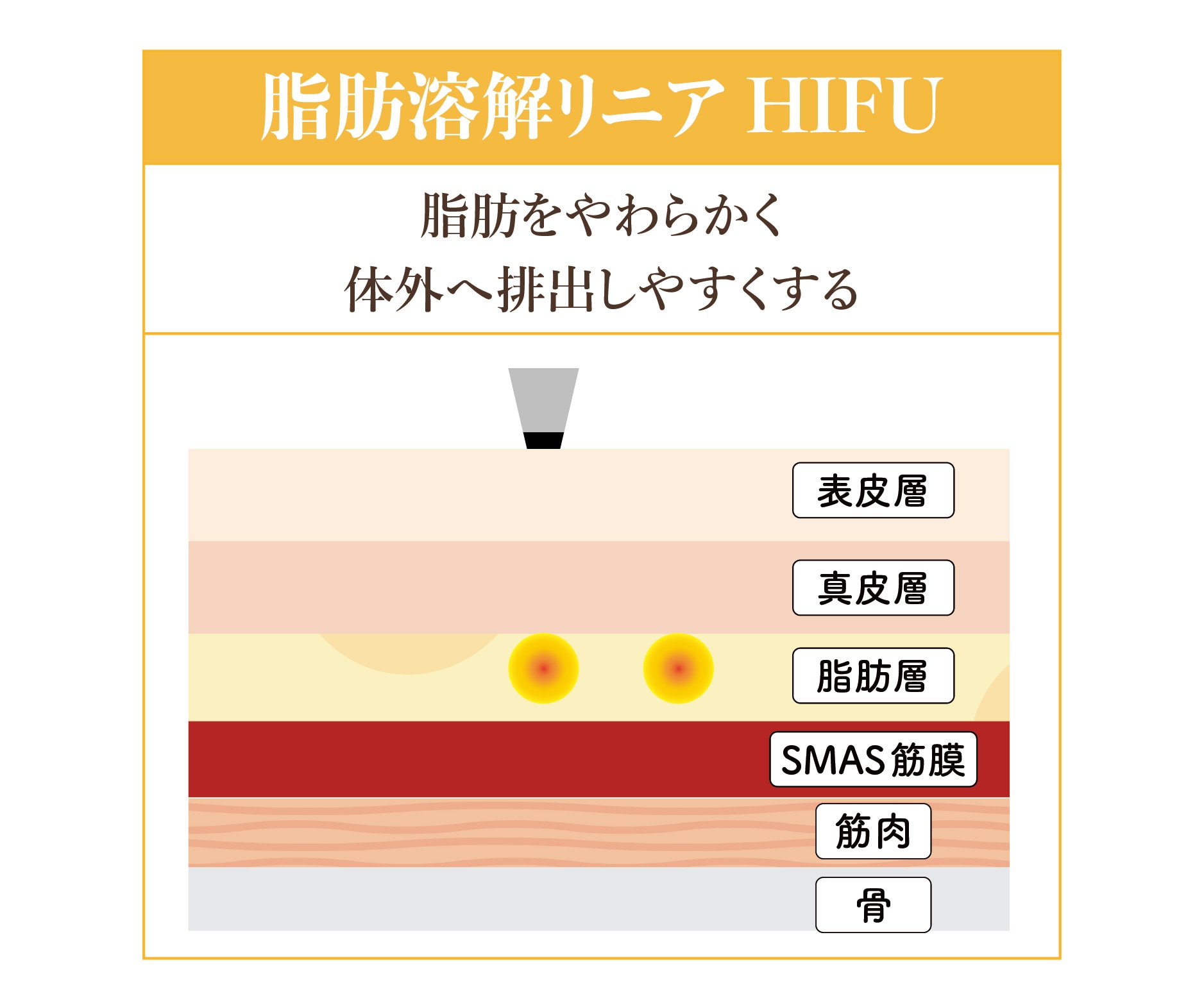 ① 脂肪溶解リニアHIFU / 脂肪層