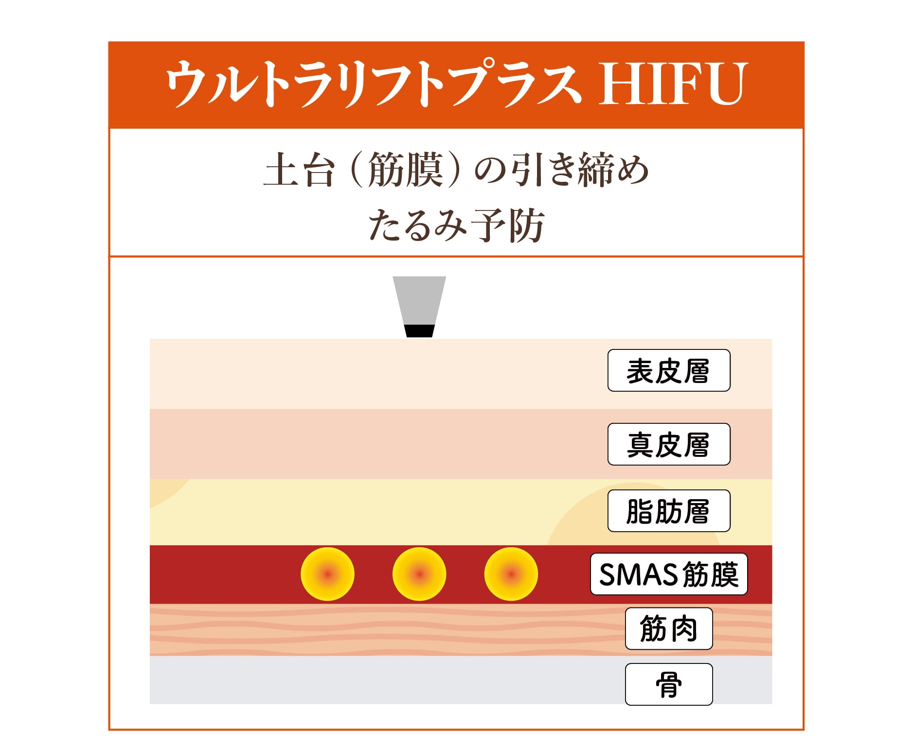 ② ウルトラリフトプラスHIFU / 筋膜層