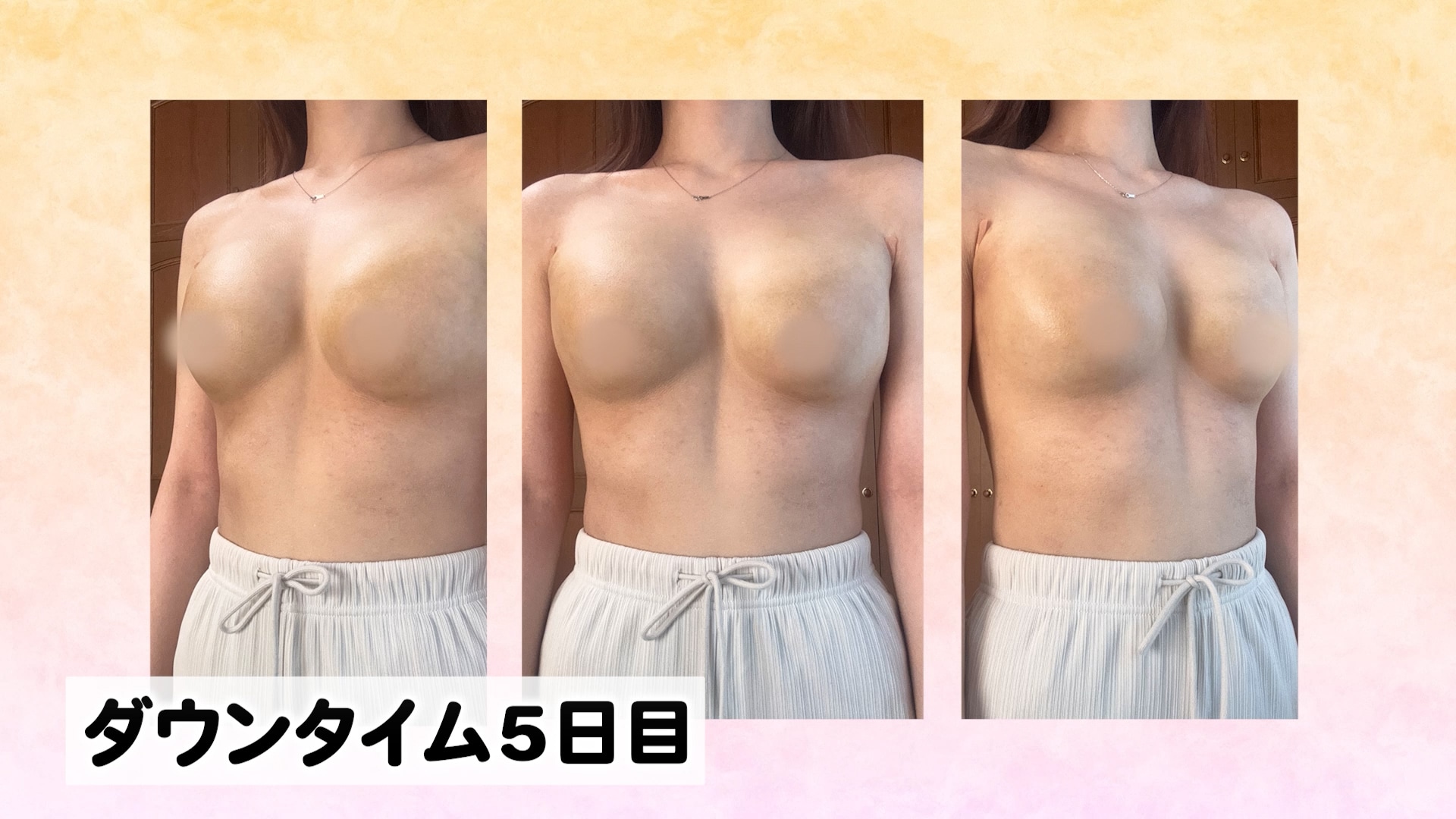 着圧の脱ぎ着の痛み