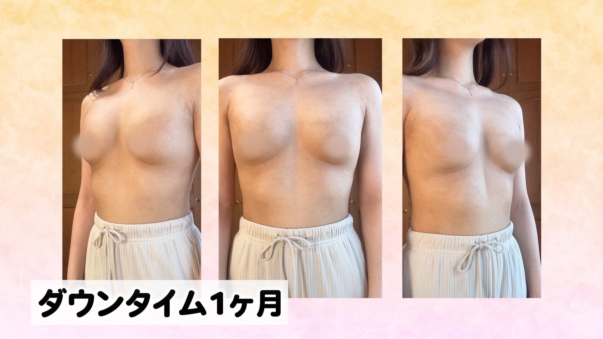 豊胸1ヶ月後の様子