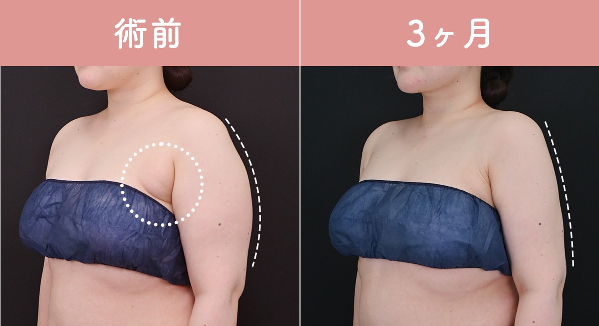 　　　　20代後半　160cm 75.9kg BMI29.6 <br />
アキーセル脂肪吸引（二の腕全周+肩+肩甲骨上＋背中＋胸上部）