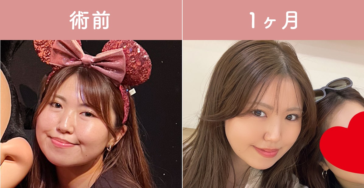 ①笑うと頬がアンパンマンのように膨らむ方