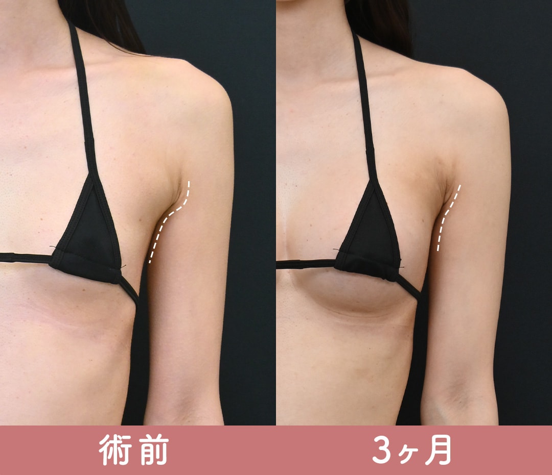 ハイブリッド豊胸、副乳脂肪吸引・エンブレイス