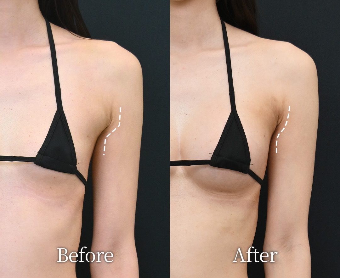 豊胸、副乳脂肪吸引・エンブレイスRF