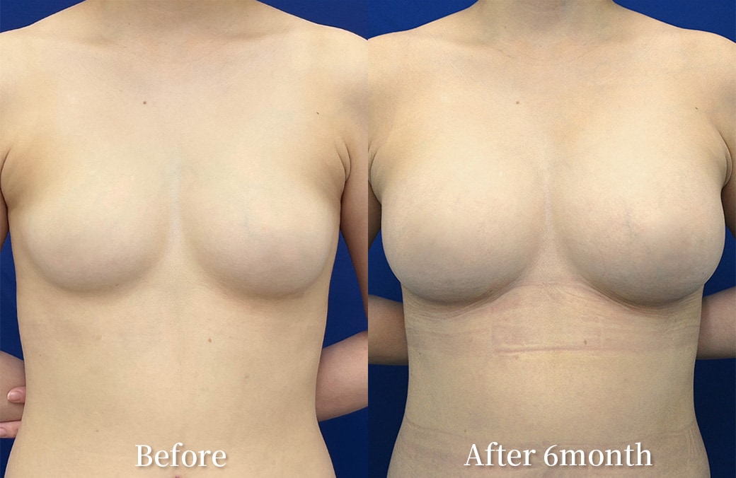 10代 脂肪注入豊胸