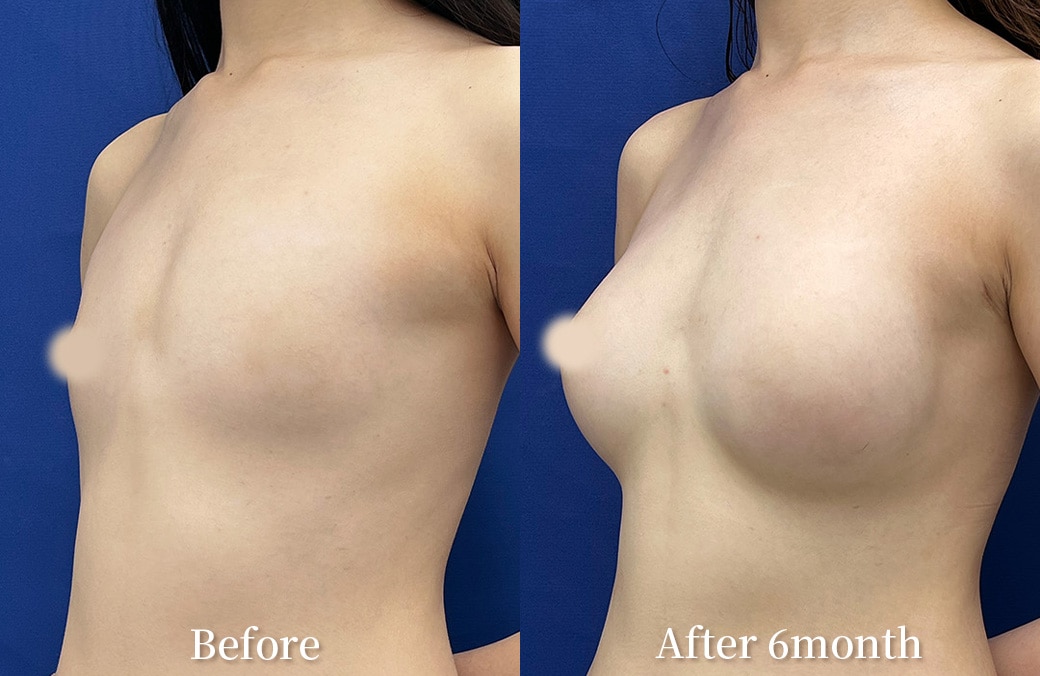 10代 ハイブリッド豊胸