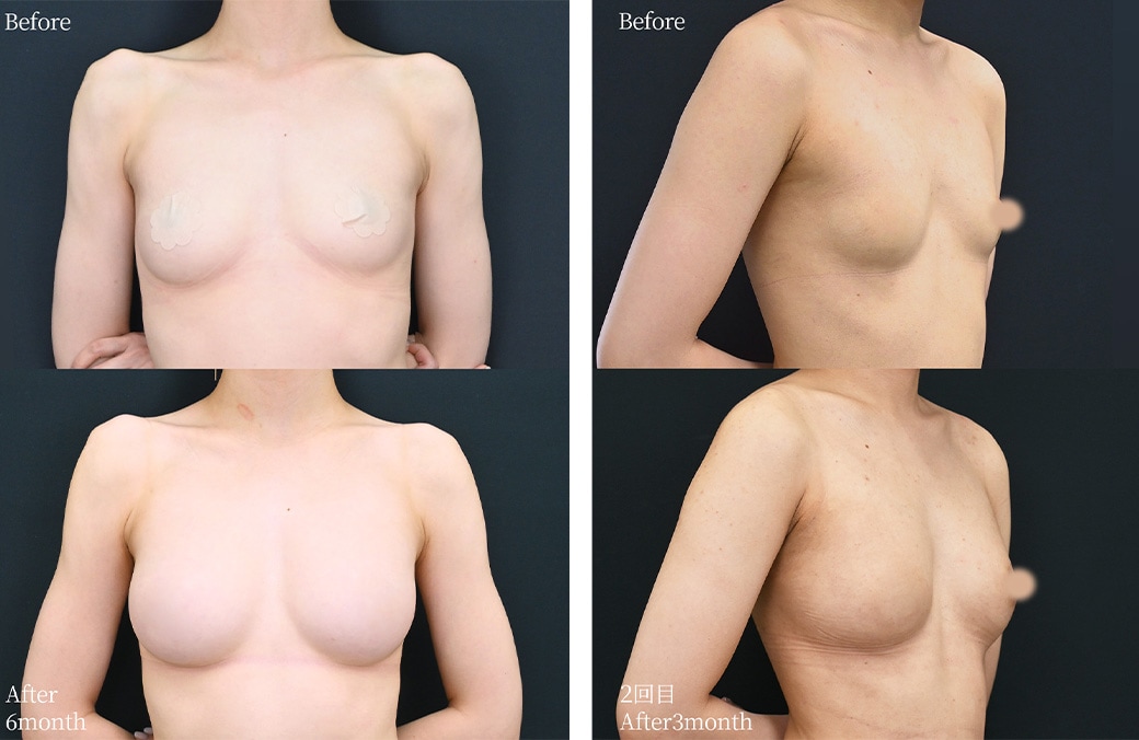 20代 脂肪注入豊胸