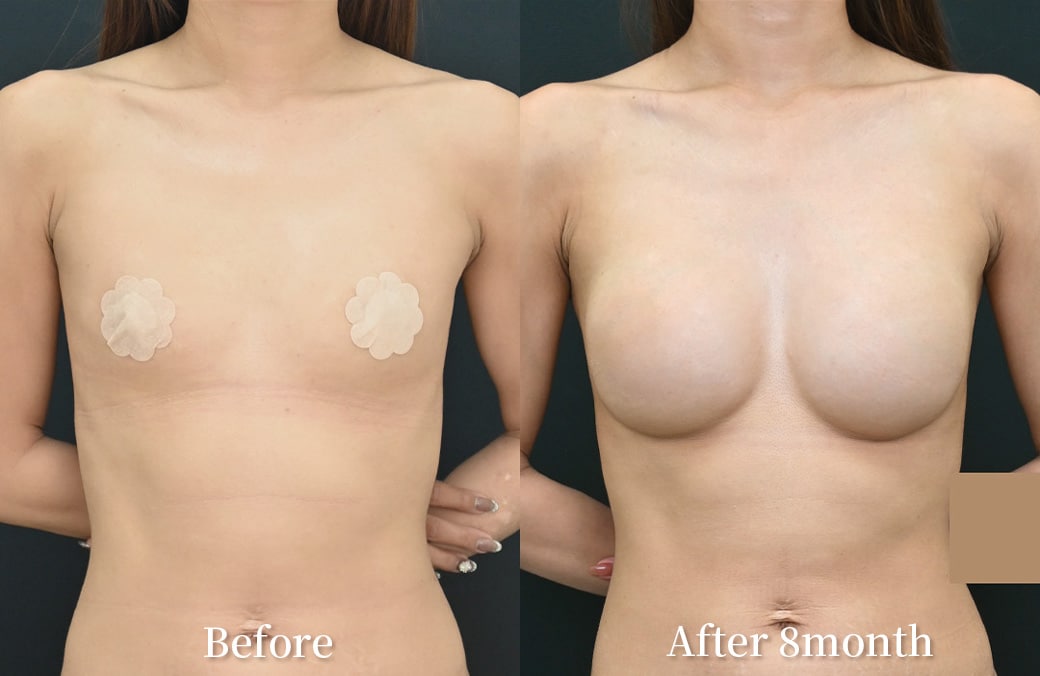 30代 ハイブリッド豊胸